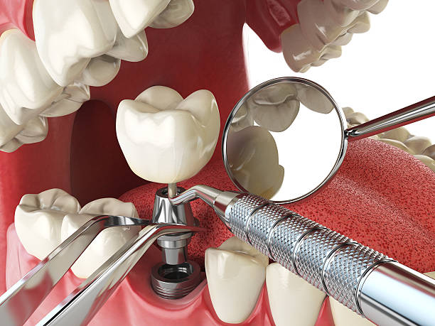 Best Emergency Root Canal Treatment in Phoenix, IL